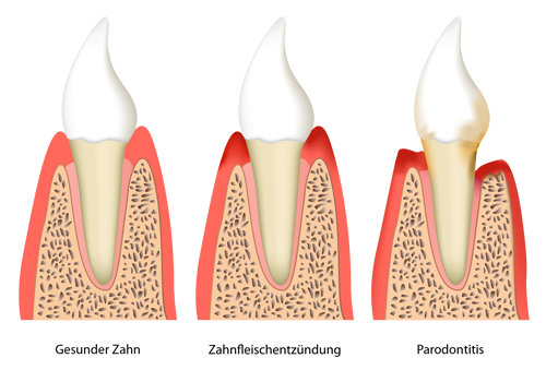 Die Parodontitis bezeichnet eine bakterielle Entzündung des Zahnbettes.