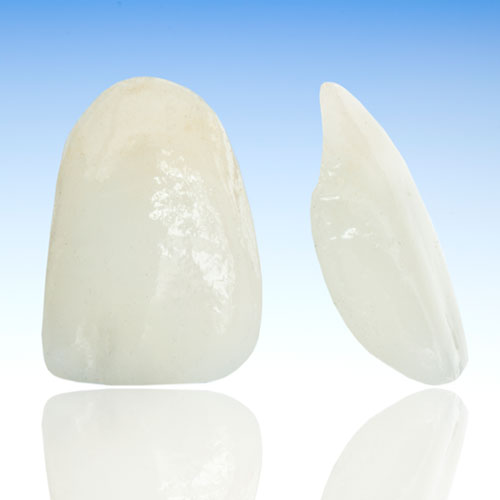 Mithilfe von Veneers können Zahnfehlstellungen oder auch beschädigte oder verfärbte Zähne korrigiert werden. Mithilfe von Veneers können Zahnfehlstellungen oder auch beschädigte oder verfärbte Zähne korrigiert werden.