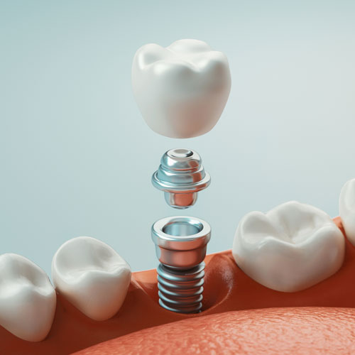 Zahnimplantate zum Ersatz eines einzelnen Zahns